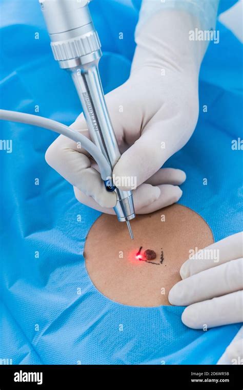 tehnica quirurgica de exeresis a fibroadenomatoidului